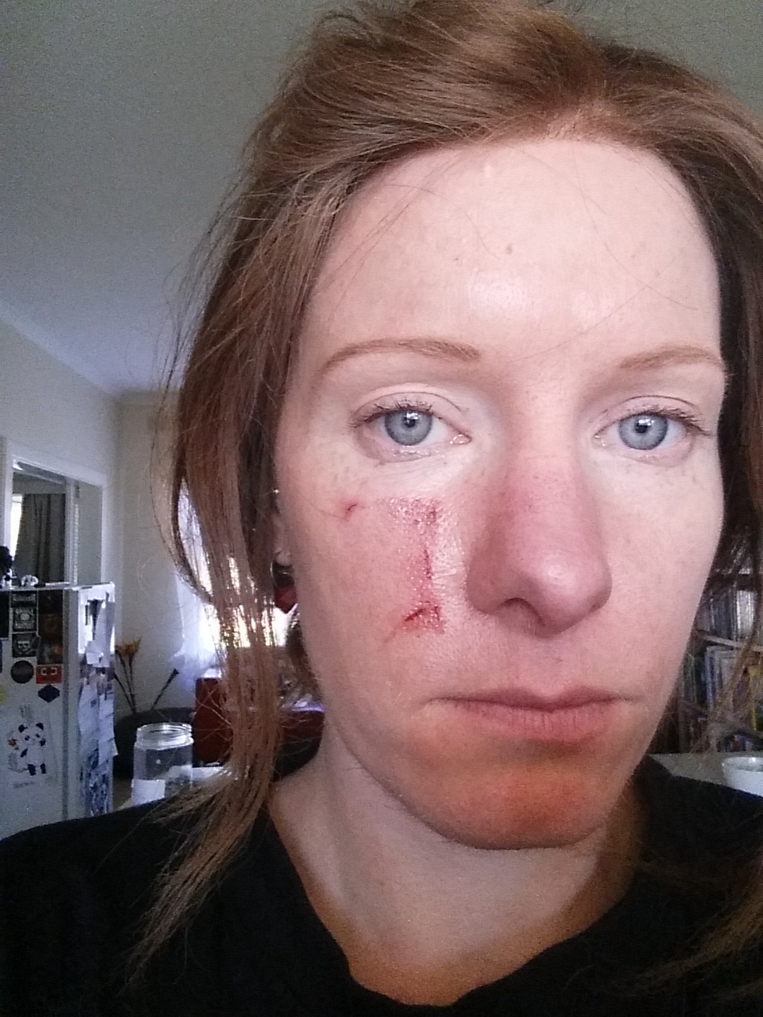 woman versus steel pole - photo of the injury
